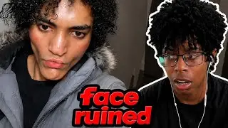 this looksmaxxer ruined his face…