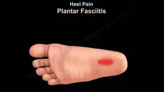 Heel Pain, causes and treatment, plantar fasciitis diagnosis and treatment.