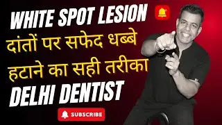 The Hidden Epidemic: White Spot Lesions Explained BY DELHI DENTIST