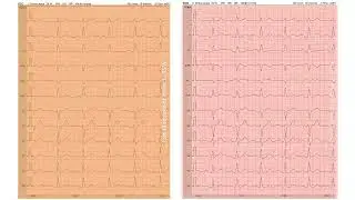 Stress ECG interpretation - eFundi and OBS Studio Example