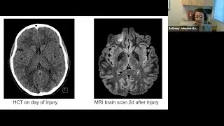 Pediatric Mild Traumatic Brain Injury | UCSF Neurosurgery Community Grand Rounds