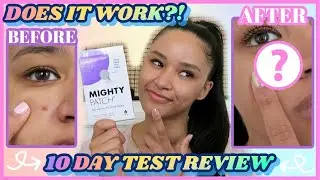 DOES IT WORK?! - Hero Mighty Patch for Removing Dark Spots - 10 DAY TEST REVIEW