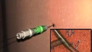 Bile Ducts--NK2 KIT-Using Metal Stiffening cannula Method.mpe