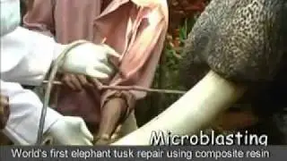 Root Canal -- Elephant Tusk Repair using composite resin(World's First ).flv