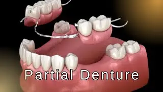 Partial Denture