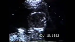 BABY'S 1ST PICTURE 19 WEEKS ULTRASOUND NOV 10 1992 CHRISTOPHER K