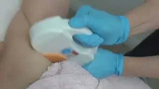 SHR hair removal