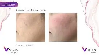 Venus Velocity&trade; & Venus Epileve&trade; | Professional Laser Hair Removal Solutions for Your Business