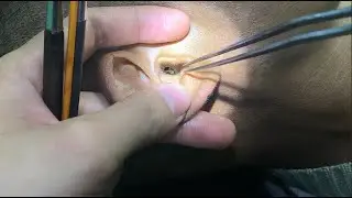 quick earwax removal  #earwax #earwaxcleaner #earwaxremoval