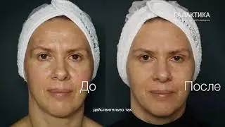 Отзыв пациента и врача клиники ГАЛАКТИКА о ELLISYS SENSE