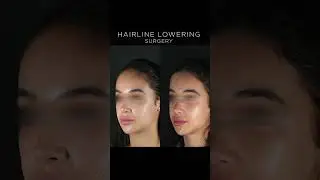Hairline Lowering Surgery - Before & After