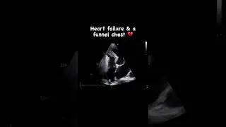 Heart failure & a funnel chest 💖
