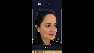 Rhinoplasty 3 Months Post-Op | Results by Dr. Daniel Golshani