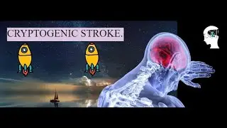 Cryptogenic stroke
