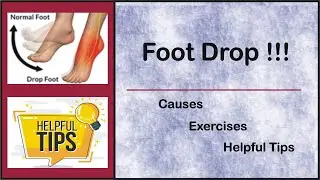 BEST Exercises for Foot Drop |  Helpful tips for Foot drop