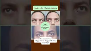 Squint Treatment without Surgery-Online Vision Therapy #visiontherapyworks #BestVisiontherapyClinic
