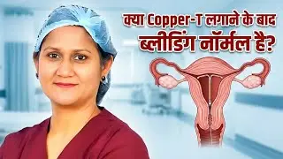 क्या Copper-T लगवाने के बाद bleeding normal है?