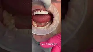 Zirconium Crowns Transformation at Dentatur in Turkey #dentatur #dentalcrownsturkey