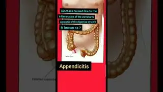 Diseases caused due to the inflammation of the vermiform appendix of the digestive system known as