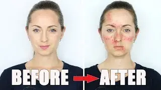 HOW TO MAKE ACNE Makeup Tutorial  / HalloweenXTRA 3 (2017)