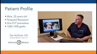 Hairline Lowering Hair Transplant Austin, Texas