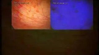 Autofluorescent Endometriosis laparoscopy 2