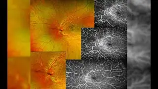 June 2025 Image of the Month | Wyburn-Mason Syndrome | Austin Retina Associates