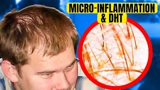 How Microinflammation and DHT Sensitivity Weakens Follicles