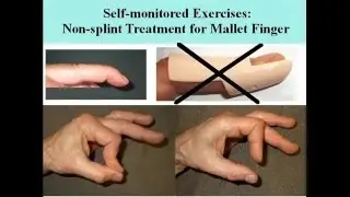 Mallet finger injury no splint treatment by hand exercises. Extensor tendon trauma at DIP joint.