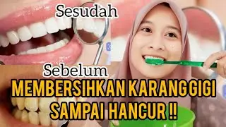 TIPS BERSIHKAN KARANG GIGI SAMPAI HANCUR !!!😱😱