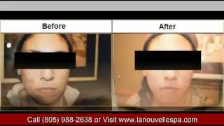 Acne Treatments Before and After by Dr Hanna | La Nouvelle Medical Spa