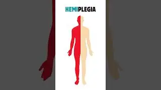 TIPOS DE PARALISIA #anatomia #enfermagem #enfermagemdigital