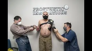 Shoulder Disarticulation Espire Elbow Placement | Prosthetic Innovations