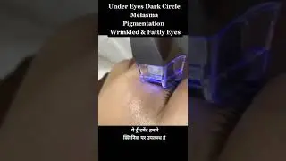 Under Eyes Black Dark Circle & Wrinkle Treatment || #shorts
