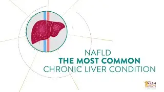 Why early diagnosis of NASH is important