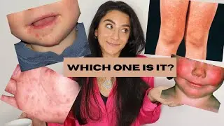 Pediatric rash- which one is it? | Doctor explains
