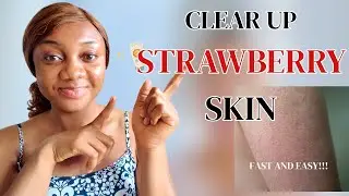 How I Got Rid of Strawberry Skin in 1 Week with ONE Product | Keratosis Pilaris Treatment!