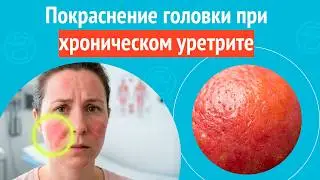 😡 Покраснение головки при хроническом уретрите. Клинический случай № 1733
