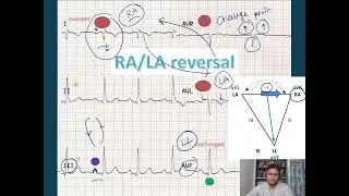How to Easily identify lead reversal in ECG, learn with examples and simple explanation