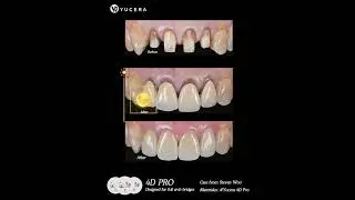Transform Your Smile: Stunning Zirconia Block Dental Makeover | Before & After