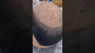 Hair patch charge your look just 1 hr #viral #youtube #youtubeshorts #subscribe