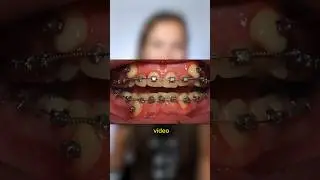 Si tienes los dientes muy API&Ntilde;ADOS, este time lapse de brackets te va a INTERESAR