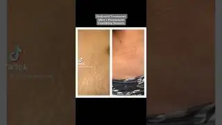 #shorts #stretchmarkremoval #stretchmarks #treatment #edu