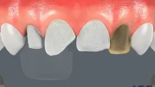 Dr. Michael LeFebvre, Comsetic Dentist in Encinitas, CA, Shares Video on Porcelain Veneers