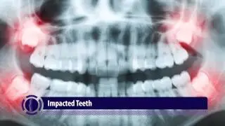 Abnormalities in Tooth Quantity | Orthodontic Video Production