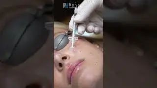 Fraxel C02 for Scars