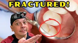 Cracked Tooth: Signs, Symptoms, and What to Do Next | View Mobile Dental