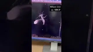 MRCP SHOWING  BILIARY TREE.  #MRI  #gallbladderstones