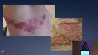 Simposio II Pt2 - 11  Efectos adversos de las terapias biológicas   Dra  Carolina Taricco