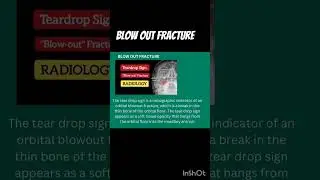 Blow out Fracture #aiapgetpreparation #medicallectures #shorts #neetpg